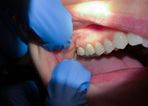 Best Broken or Chipped Tooth Repair in Mokena, IL